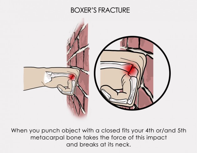 boxer's fracture treatment 