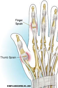 How To Treat A Jammed Finger. Not Getting Better? Try This. - Youtube