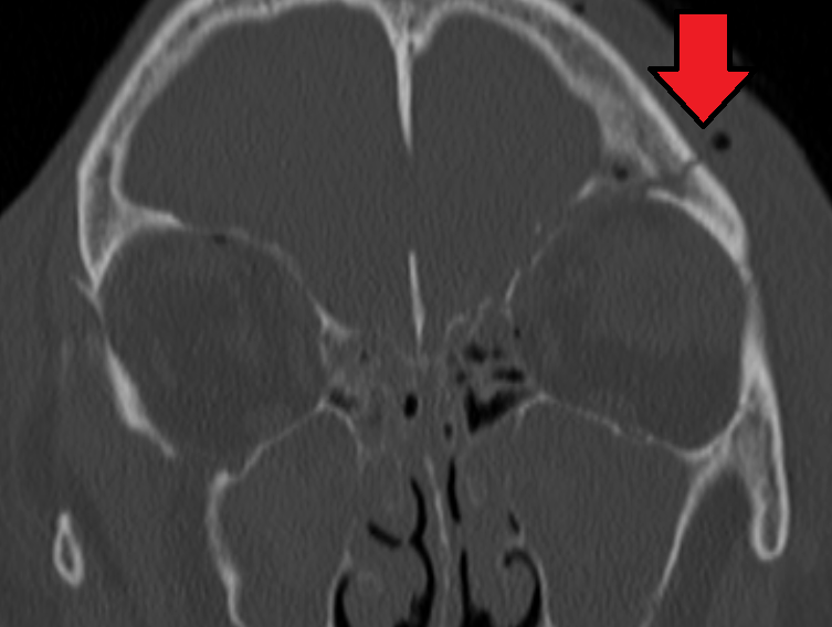 Skull Fracture