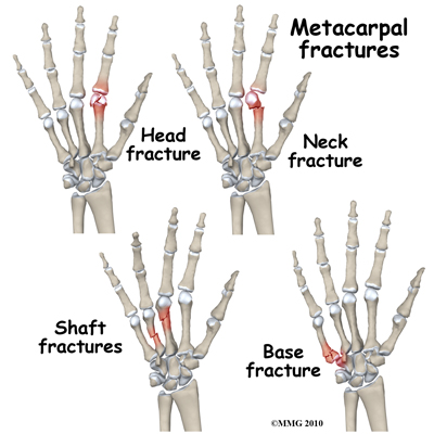 metacarpal fractures