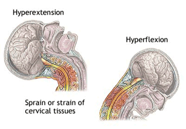 neck strain neck strain