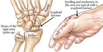 scaphoid fracture surgery)