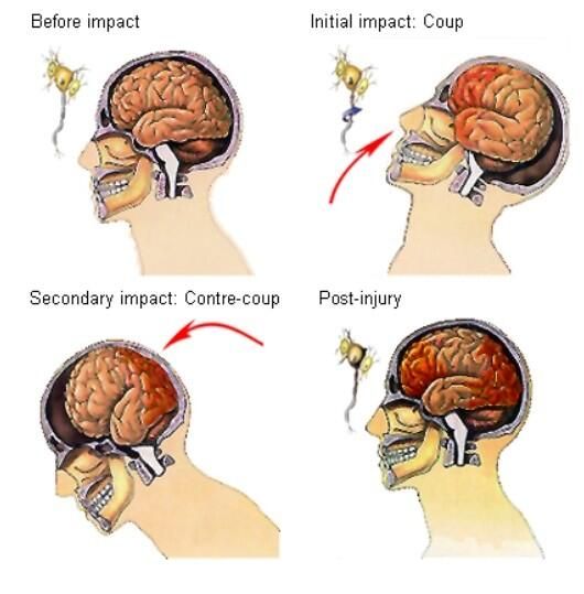 How to Tell If You Have a Concussion