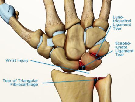 ligament scapholunate tear injury injuries radial symptoms mild