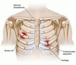 And sternum popping pain Costochondritis