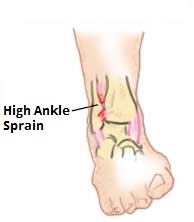 recovery time for high ankle sprain, high ankle sprain