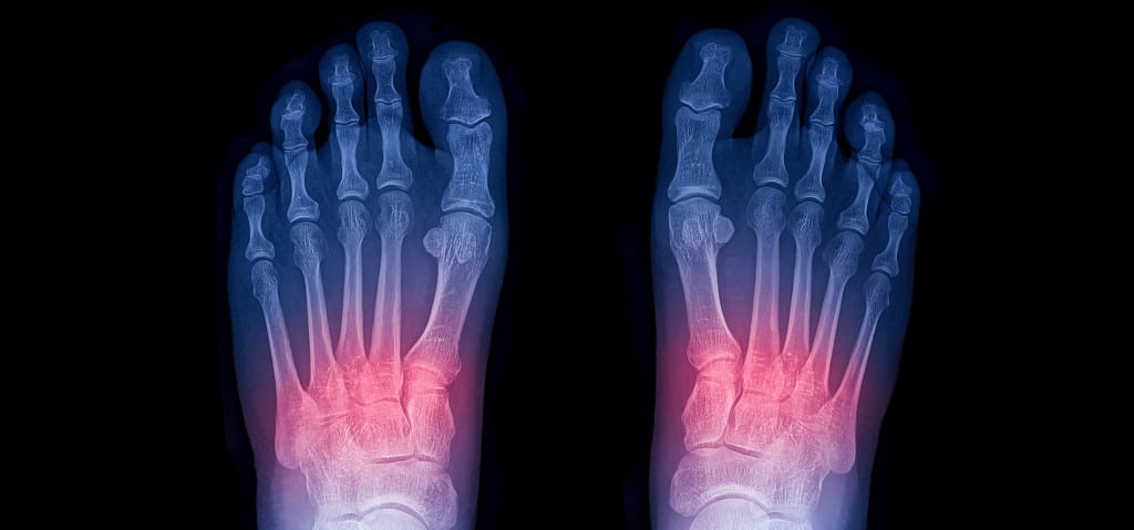 mid-foot sprain