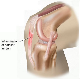 patellar tendonitis