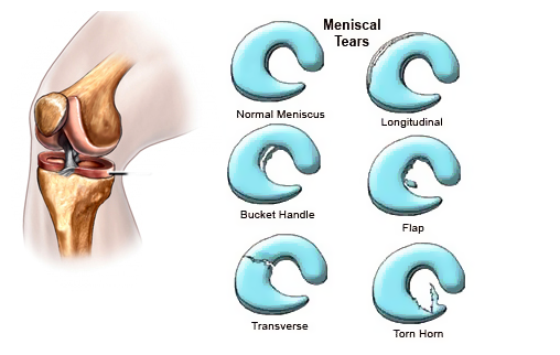 medial meniscus tear