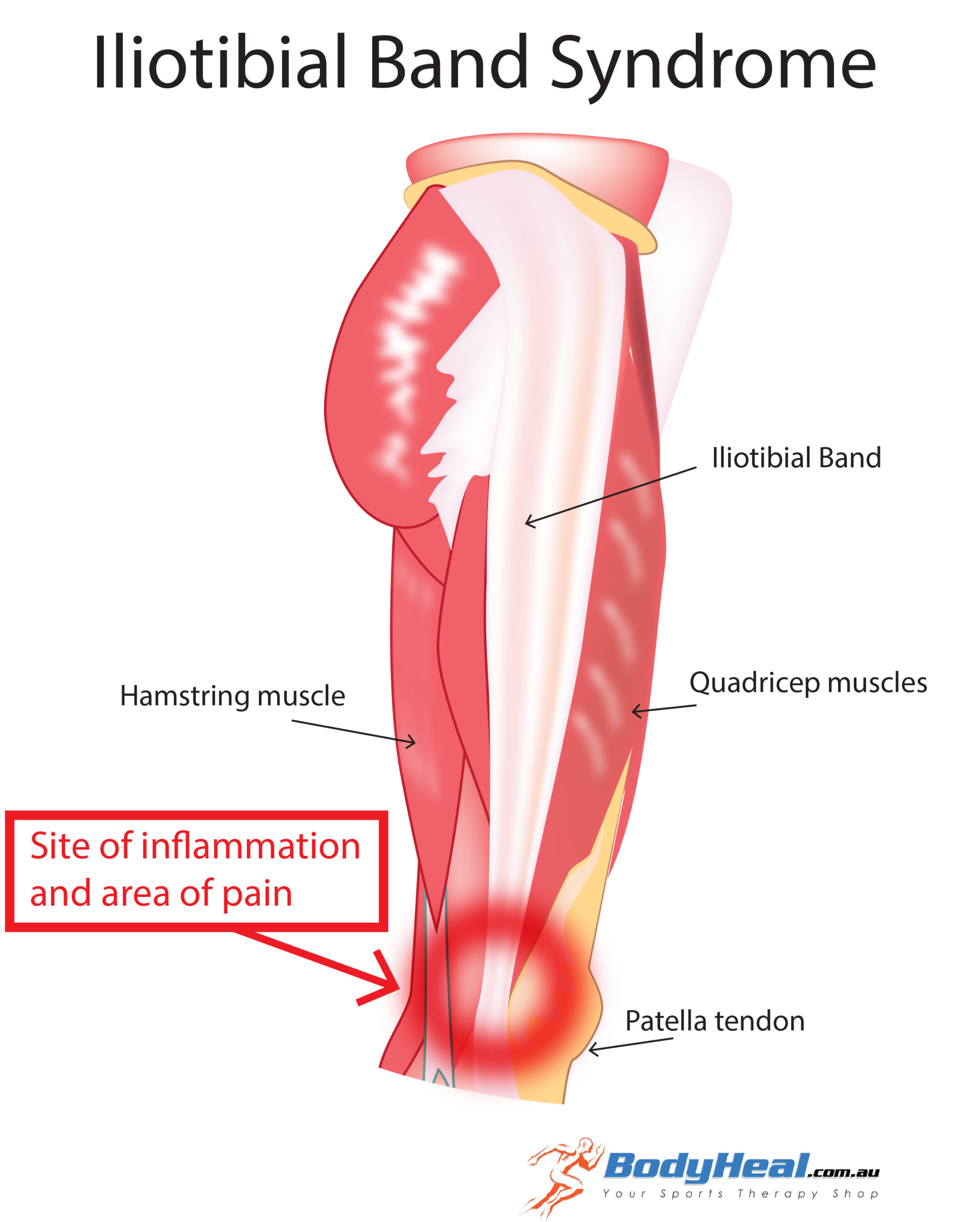 IT Band Syndrome, Treatment, stretches, recovery