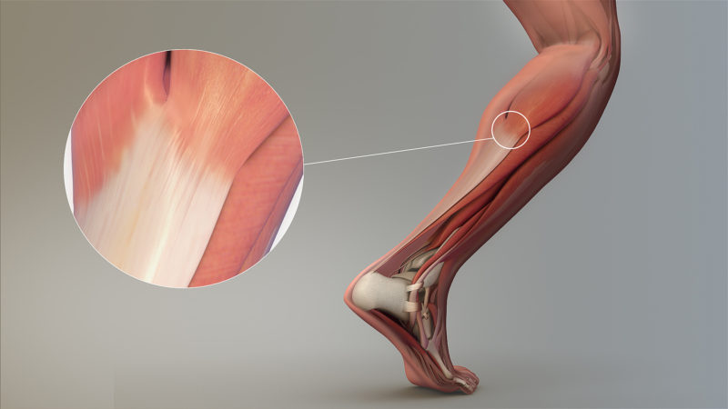 Tendon Pain: Do you have to accept pain to play a sport? SportsMD