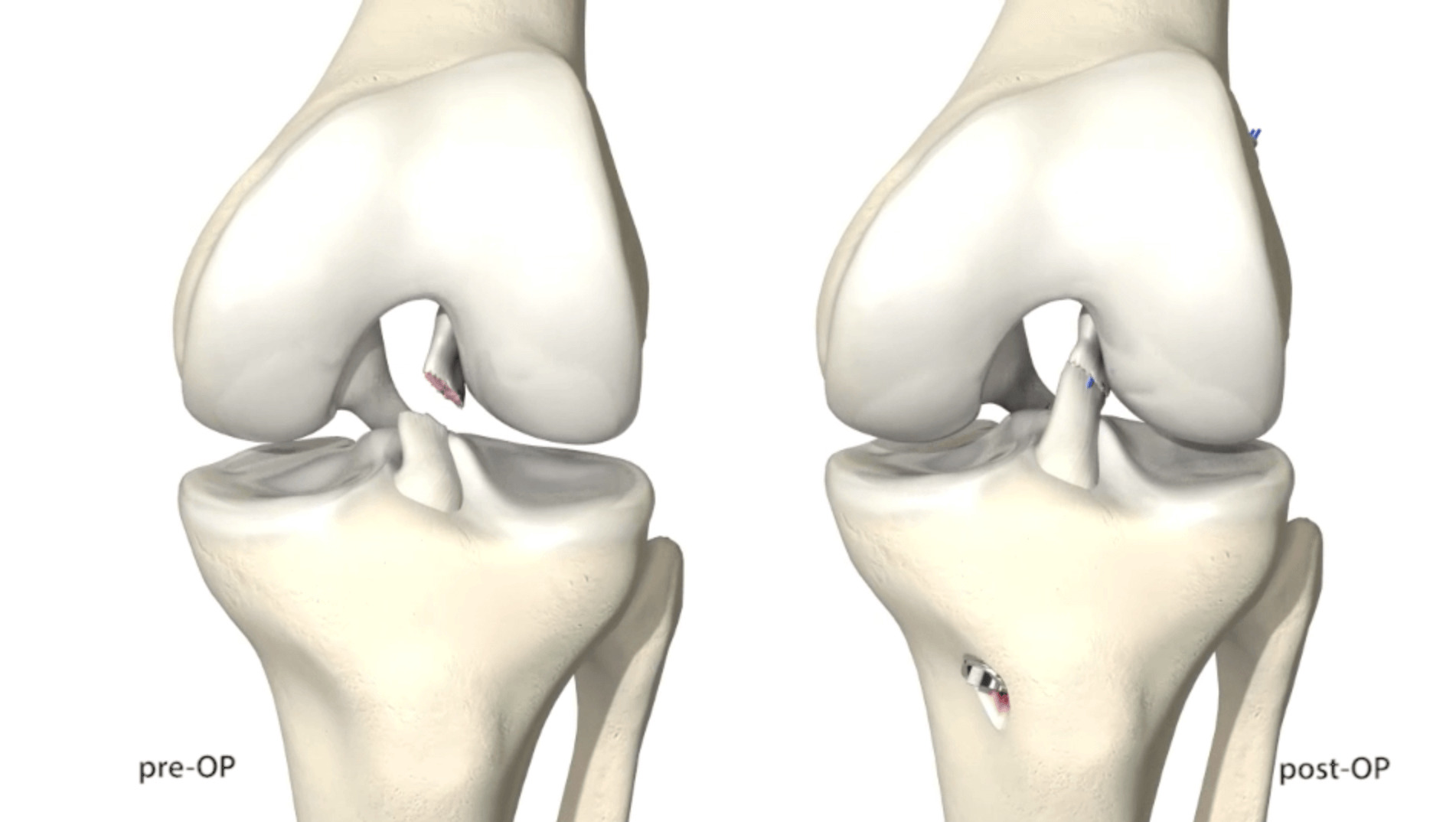 Torn ACL in Knee Symptoms, treatment, surgery, recovery & MRI ...