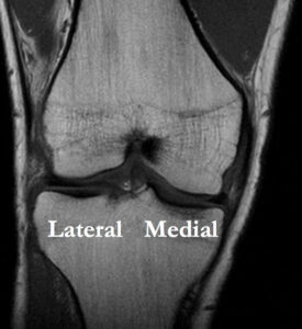 tibial plateau fracture Lateral Medial