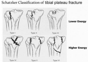 tibial plateau fracture surgery