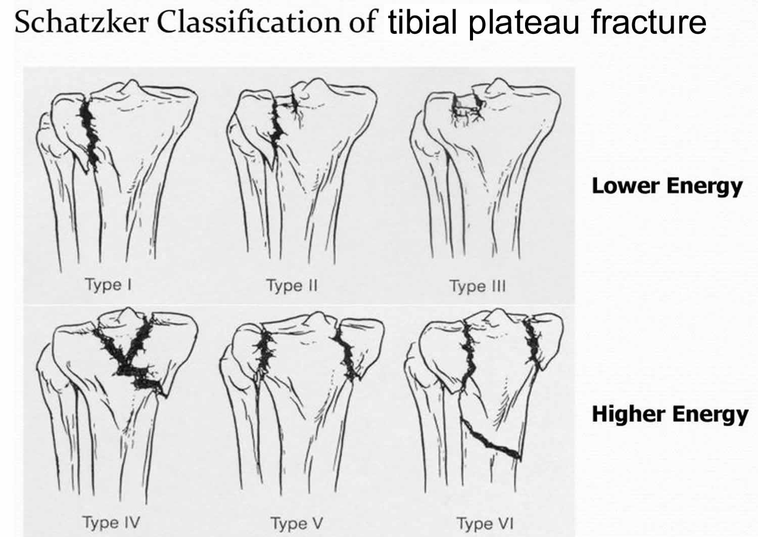 Tibiaplateau Fractuur Prognose Fracture Plateau Tibial Anatomie JTEV