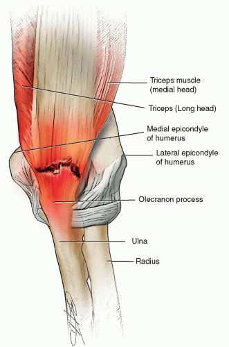 Tricep pain after workout online