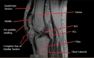 Patellar tendon tear mri