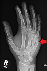 boxers fracture x-ray