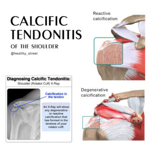 Calcific Tendonitis surgery