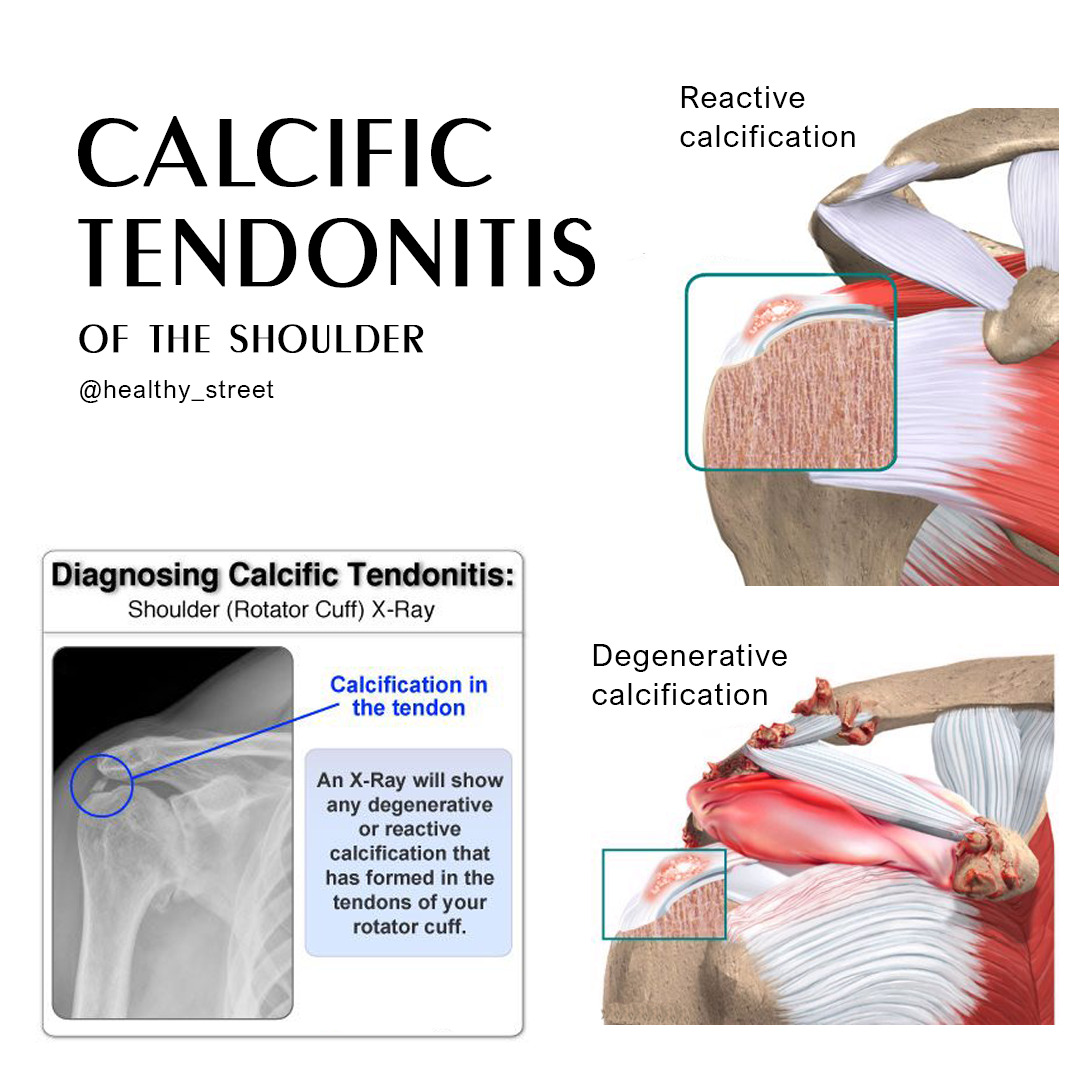 Tendonitis as related to Calcium Pictures