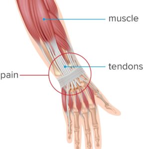 wrist tendonitis