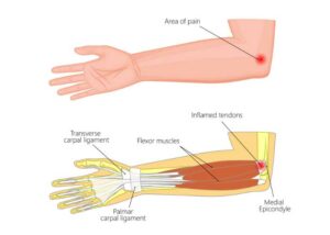 Golfers elbow location