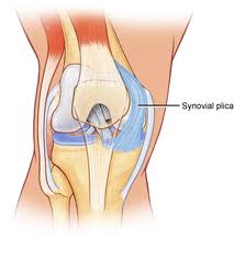 plica syndrome