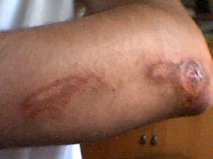 Abrasion