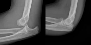 elbow dislocation