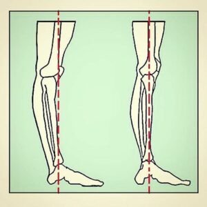 knee Hyperextension