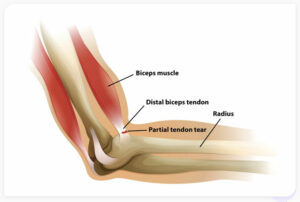 distal biceps tendon tear rupture