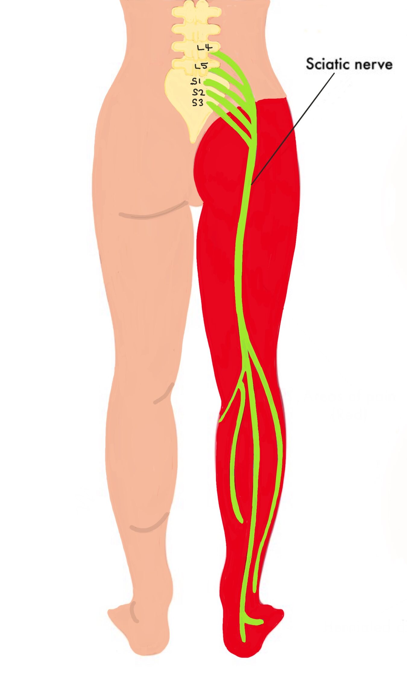 Sciatic Pain Associated With Lumbar Disc Conditions Sciatic Pain Associated With Lumbar Disc Conditions